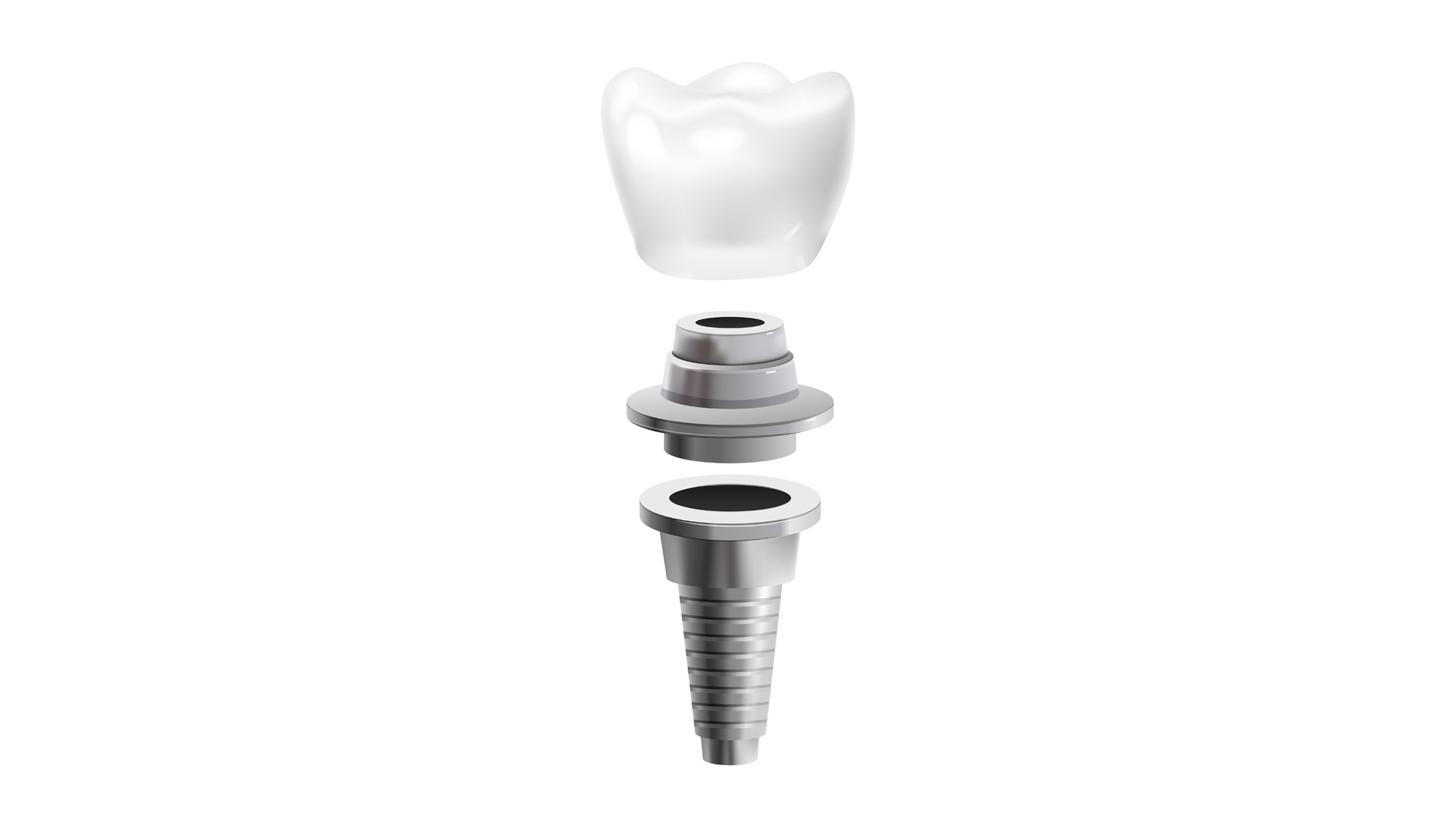 Implantat-Zahnbehandlung