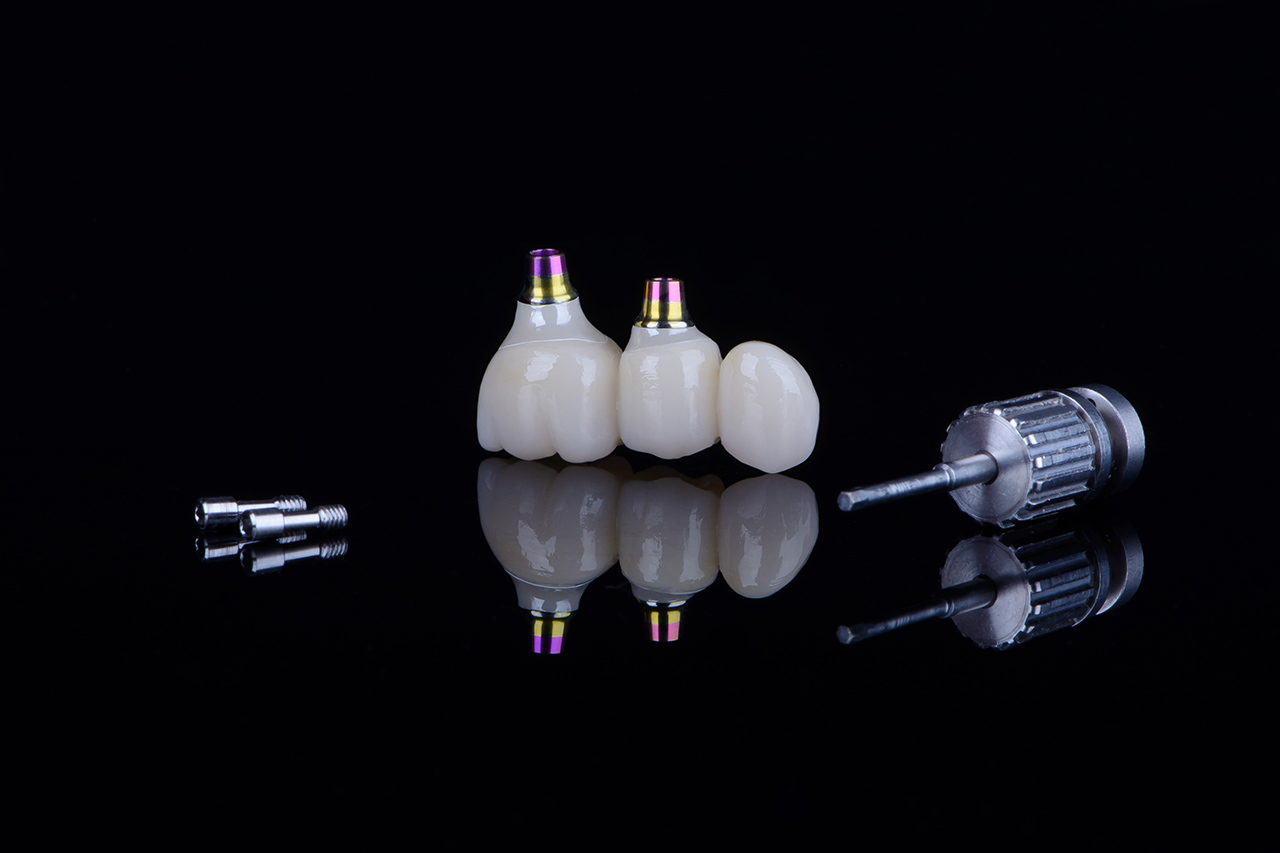All-on-4 vs All-on-6 Implantatbehandlungsoptionen: Welche ist die Richtige für Sie?
